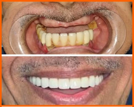 best dental implant in mumbai